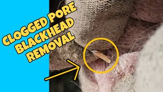 HUGE Clogged Pore Blackhead pimple REMOVAL on Popbelly Pig skin pimplepopping skincare oddly [upl. by Barhos936]