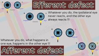 Pupil 2  Characteristics of Afferent and Efferent Pupillary Defects [upl. by Haland]