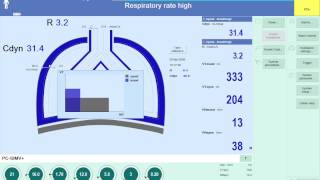 SmartPulmonary View in action Asynchrony [upl. by Mitchiner]