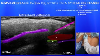 Ultrasound Guided Scapulothoracic Bursa Injection in a 32 Year Old Female by probeultrasoundcom [upl. by Phillis891]