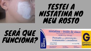 MINHA EXPERIÊNCIA COM A POMADA NISTATINA NO ROSTO  COMO CLAREAR MANCHAS DE ESPINHAS [upl. by Saphra690]