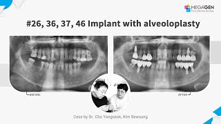 Dr Yongseok CHO Sewoung KIM 26363746 implant with alveoloplasty [upl. by Brigette805]