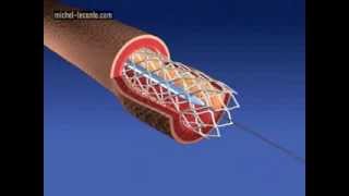 coronary artery stenting [upl. by Onairpic870]