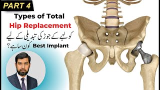 Types of Hip Replacement Part 4 in Urdu Hindi  Dr Muhammad Bilal Orthopedic Surgeon [upl. by Nairadas]