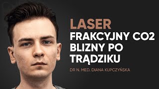 Blizny potrądzikowe na policzkach  laser frakcyjny CO2 [upl. by Ened]