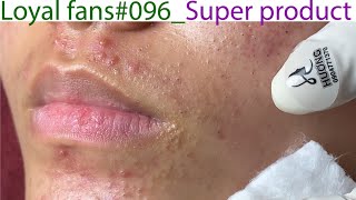 Acne Treatment Huong Da Nang 096  Loyal fans  Super product [upl. by Arda]