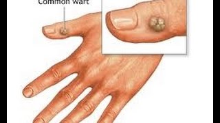 How to get rid of warts on neck fingers and hands [upl. by Jocelin]