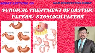 SURGICAL TREATMENT OF STOMACH ULCERS  GASTRIC ULCERS VAGOTOMY PYLOROPLASTY GASTRODUODENOSTOMY [upl. by Hamnet276]