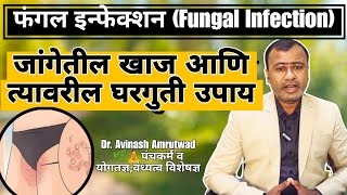 फंगल इन्फेक्शन  Fungal Infection जांगेतील खाज  आणि त्यावरील घरगुती उपाय  helthtips fungal [upl. by Novj541]