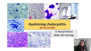 Hyalinizing Cholecystitis Rare histological variant [upl. by Eilema]