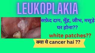 leukoplakiawhite patch causes and treatment [upl. by Vivyanne]