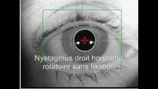 Nystagmus horizontal et rotatoire sans et après fixation [upl. by Anaerdna]