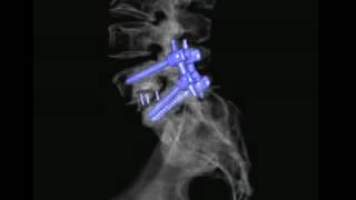 L 5S1 Posterolateral and interbody fusion [upl. by Atnohs]