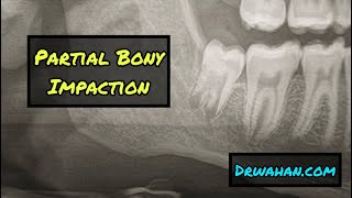 Mesioangular Wisdom Tooth Impaction Extraction drwahan [upl. by Phelgon188]