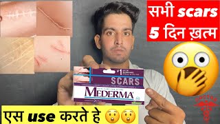 use यसे करते हे 😲  Mederma cream  Mederma advanced scar gel review  Mederma cream ke fayde scar [upl. by Alper]