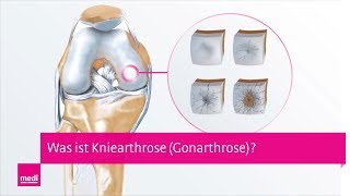 Arthrose im Knie  Was ist Gonarthrose Kniearthrose – Ein Blick ins Innere des Kniegelenks [upl. by Attenohs688]