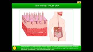 Trichuris Trichiura  Parásitos intestinales Desnutrición [upl. by Jopa]