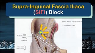 SupraInguinal Fascia Iliaca SIFI Block  the SUPRAINGUINAL approach [upl. by Asirem108]