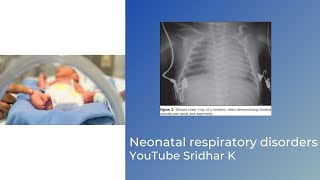 Neonatal Respiratory disordersan overview Dr Sridhar Kalyanasundaram [upl. by Dimah644]