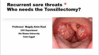 Recurrent sore throats Who needs the Tonsillectomy [upl. by Acilgna]