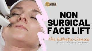 Non Surgical Face Lift Treatment  Ultherapy For AntAging by Dr Debraj Shome [upl. by Gussy]