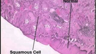 Understanding Esophageal Cancer Part I Introduction [upl. by Godard]