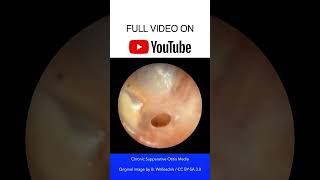 Chronic Suppurative Otitis Media Otoscopy [upl. by Llemhar]