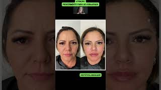 Tratamento de Lifting com Fios Fios de sustentação facial antes e depois [upl. by Nawiat]