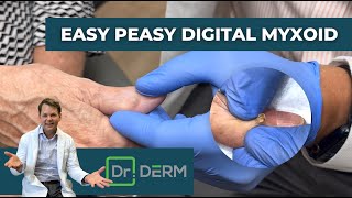 Easy Peasy Digital Myxoid  Dr Derm [upl. by Mae]