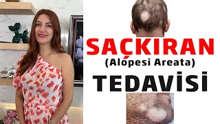 Saçkıran  Alopesi Areata  Tedavisi [upl. by Letha955]