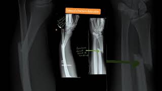 Galeazzi fracture dislocation [upl. by Annahsat]