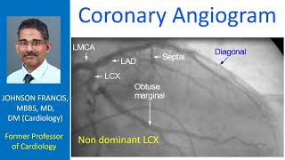 Coronary Angiogram [upl. by Cleres969]