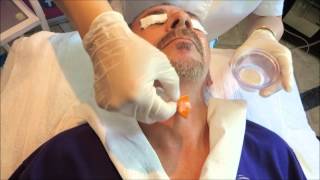 Virtual Mesotherapy Electroporation treatment [upl. by Nomaj]