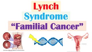 Lynch Syndrome Hereditary NonPolyposis Colorectal Cancer Genetics Symptoms Diagnosis Treatment [upl. by Phionna]