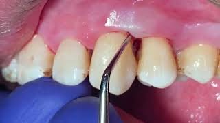 Minimally Invasive NonSurgical Technique MINST to Treat Periodontitis Stage III Grade C [upl. by Buerger]