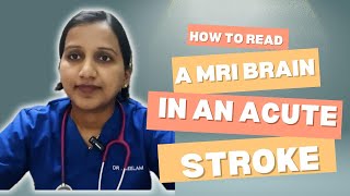 How to Read a MRI in an Acute Stroke [upl. by Aryl669]