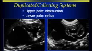 RenalAdrenalRetroperitoneal Ultrasound [upl. by Viafore]