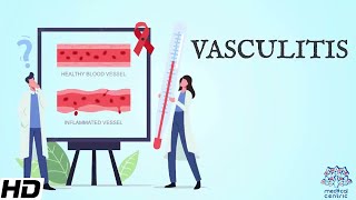 Vasculitis Everything You Need To Know [upl. by Whitaker194]