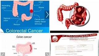 Colorectal Cancer Rectum carcinoma Responded by Dr Arpit Chopra Jain ModernHomeopathy saved surgery [upl. by Charters107]