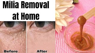 BEAUTYampCAREEPI91WHAT IS MILIA MILIA TREATMENTHOW TO REMOVE MILIA AT HOMESCRUBFACE MASKMILIA [upl. by Nigem]