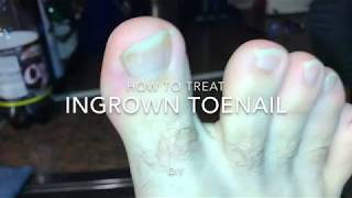 How to treat Ingrowing toenail with a scissor and an edge lifter DIY [upl. by Tait779]