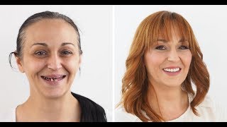 Dentalni makeover 2018 ŠTIMAC CENTRA DENTALNE MEDICINE  Mirela [upl. by Shorter]