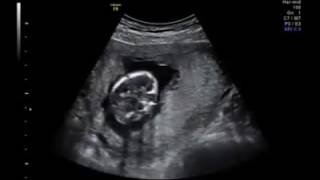 PAPADIMITRIOU – 12 weeks Chorionic Villus Sampling CVS [upl. by Tammie]