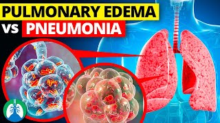 Pulmonary Edema vs Pneumonia [upl. by Esmond693]