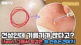 압출smr 102 건조하고 작은 좁쌀 여드름 압출  30대 女 [upl. by Laing]