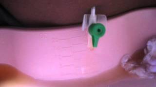 Drainage of Ascites using abdominal paracentesis [upl. by Asirral396]