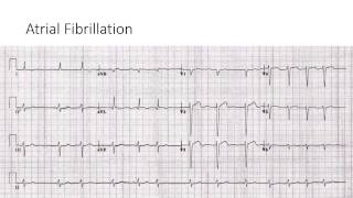 Atrial Fibrillation [upl. by Aronoel780]