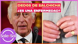 Por qué el rey Carlos III tiene dedos de salchicha  Visita de Doctor  Sale el Sol [upl. by Ydnagrub486]