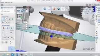 Bite Splint Design Workflow in 3Shape [upl. by Andee]