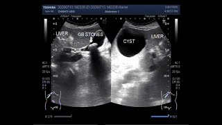 Ultrasound Video showing the Differentiation between Simple Hepatic Cyst and Hydatid Cyst [upl. by Linnea827]